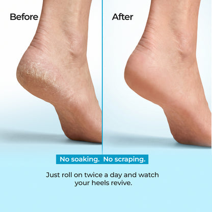 Sole Revival 20% Urea Heel Roll-On